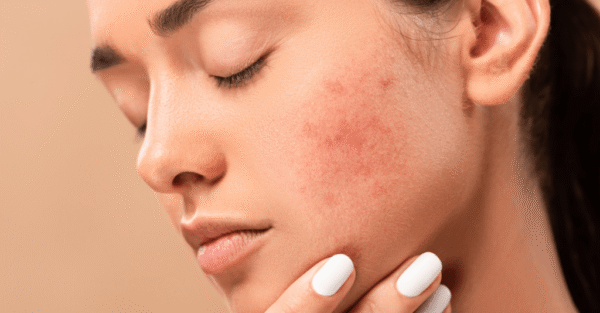 Acne Myths vs. Facts: What Really Causes Pimples?
